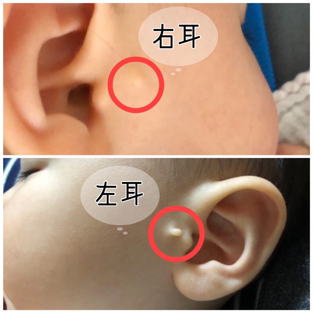 副耳とは？原因は何？
