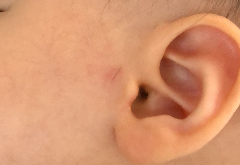 副耳切除手術後の傷口