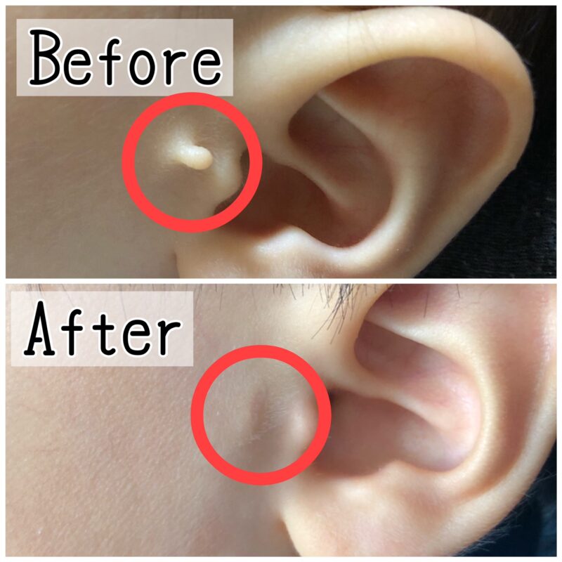 副耳切除手術のビフォーアフター